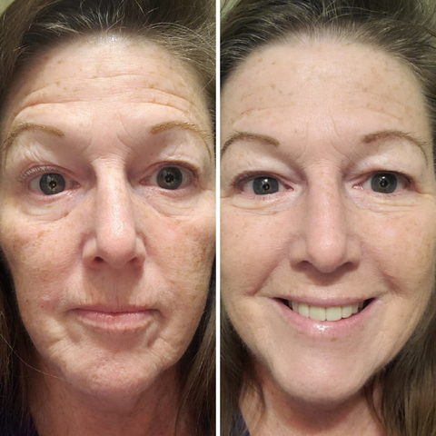 Before and after images of a woman showing improved skin texture after using Fièra Bakuchiol Facial Treatment